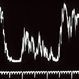 Choroidal melanoma ; A scan Choroidal melanoma ; A scan